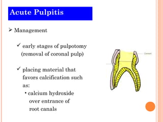 Acute Pulpitis

 Management

   early stages of pulpotomy
   (removal of coronal pulp)

   placing material that
    favors calcification such
    as:
     • calcium hydroxide
       over entrance of
       root canals
 