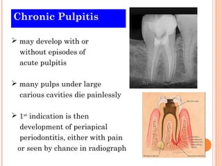 Chronic Pulpitis

 may develop with or
  without episodes of
  acute pulpitis

 many pulps under large
  carious cavities die painlessly

 1st indication is then
  development of periapical
  periodontitis, either with pain
 or seen by chance in radiograph
 