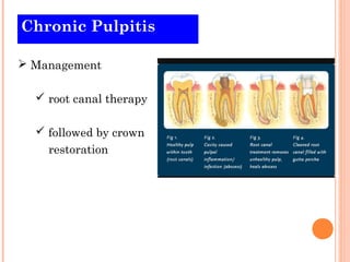 Chronic Pulpitis

 Management

   root canal therapy

   followed by crown
    restoration
 