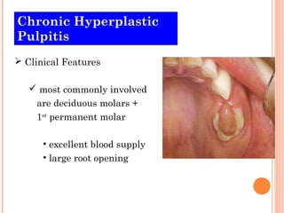Chronic Hyperplastic
Pulpitis
 Clinical Features

    most commonly involved
    are deciduous molars +
    1st permanent molar

      • excellent blood supply
      • large root opening
 