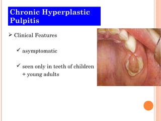 Chronic Hyperplastic
Pulpitis
 Clinical Features

    asymptomatic

    seen only in teeth of children
     + young adults
 