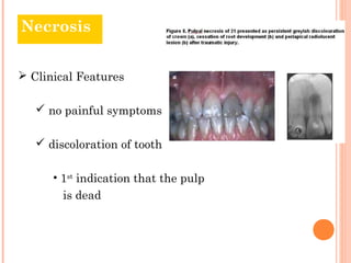 Necrosis


 Clinical Features

    no painful symptoms

    discoloration of tooth

      • 1st indication that the pulp
        is dead
 