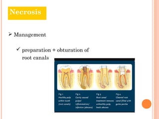 Necrosis


 Management

   preparation + obturation of
    root canals
 