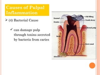 Causes of Pulpal
Inflammation
 (4) Bacterial Cause

    can damage pulp
     through toxins secreted
     by bacteria from caries
 