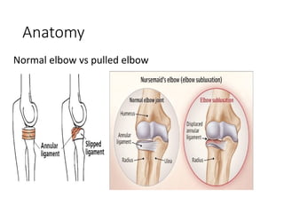 Normal Variants Elbow Comprehensive Guide to Pulled Elbow and First Aid for Choking in ...