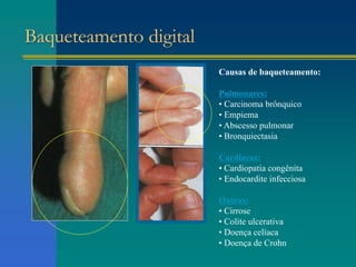Baqueteamento digital
Causas de baqueteamento:
Pulmonares:
• Carcinoma brônquico
• Empiema
• Abscesso pulmonar
• Bronquiectasia
Cardíacas:
• Cardiopatia congênita
• Endocardite infecciosa
Outras:
• Cirrose
• Colite ulcerativa
• Doença celíaca
• Doença de Crohn
 