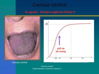 Cianose central
Se aguda - Sempre urgência clínica !!
Cianose central
pO2 de
60 mmHg
Cianose central
É generalizada e acomete mucosas !!
 