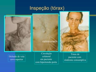 Oclusão de veia
cava superior
Circulação
colateral
em paciente
com hipertensão porta
Tórax de
paciente com
síndrome consumptiva
esplenomegalia
Inspeção (tórax)
 