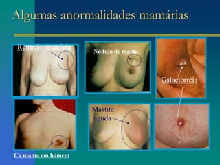 Algumas anormalidades mamárias
Mastite
aguda
Nódulo de mama
Retração mamária
Galactorréia
Ca mama em homem
 