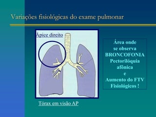 Variações fisiológicas do exame pulmonar
Área onde
se observa
BRONCOFONIA
Pectorilóquia
afônica
e
Aumento do FTV
Fisiológicos !
Tórax em visão AP
Ápice direito
 