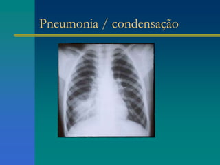 Pneumonia / condensação
 