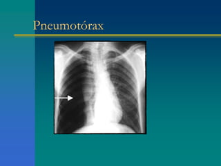 Pneumotórax
 