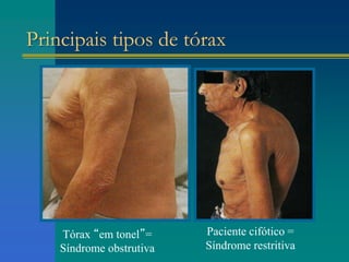 Principais tipos de tórax
Tórax “em tonel”=
Síndrome obstrutiva
Paciente cifótico =
Síndrome restritiva
 