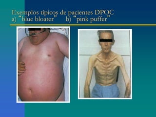Exemplos típicos de pacientes DPOC
a) “blue bloater” b) “pink puffer”
 
