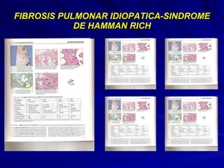 FIBROSIS PULMONAR IDIOPATICA-SINDROME DE HAMMAN RICH 