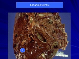 BRONCONEUMONIA R 