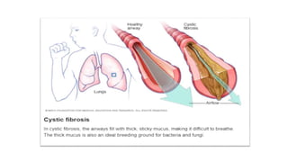 Organs Affected by Cystic Fibrosis
• Lungs
• Sinus
• Intestines
• Panaceas
• Liver
 