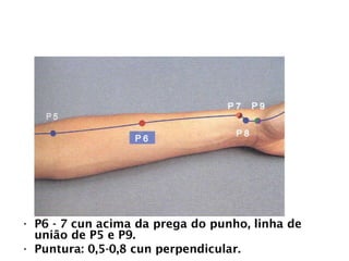 PULMÃO
• P6 - 7 cun acima da prega do punho, linha de
união de P5 e P9.
• Puntura: 0,5-0,8 cun perpendicular.
 