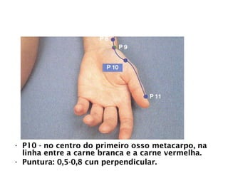 PULMÃO
• P10 - no centro do primeiro osso metacarpo, na
linha entre a carne branca e a carne vermelha.
• Puntura: 0,5-0,8 cun perpendicular.
 