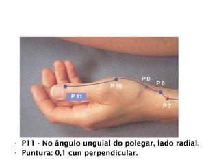 PULMÃO
• P11 - No ângulo unguial do polegar, lado radial.
• Puntura: 0,1 cun perpendicular.
 
