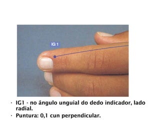 INTESTINO GROSSO
• IG1 - no ângulo unguial do dedo indicador, lado
radial.
• Puntura: 0,1 cun perpendicular.
 