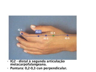 INTESTINO GROSSO
• IG2 - distal à segunda articulação
metacarpofalangeana.
• Puntura: 0,2-0,3 cun perpendicular.
 