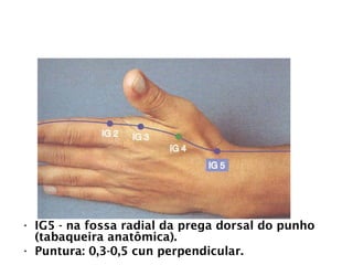 INTESTINO GROSSO
• IG5 - na fossa radial da prega dorsal do punho
(tabaqueira anatômica).
• Puntura: 0,3-0,5 cun perpendicular.
 