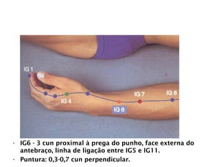 INTESTINO GROSSO
• IG6 - 3 cun proximal à prega do punho, face externa do
antebraço, linha de ligação entre IG5 e IG11.
• Puntura: 0,3-0,7 cun perpendicular.
 
