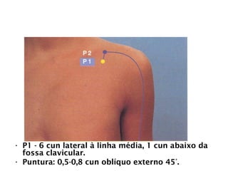 PULMÃO
• P1 - 6 cun lateral à linha média, 1 cun abaixo da
fossa clavicular.
• Puntura: 0,5-0,8 cun oblíquo externo 45°.
 