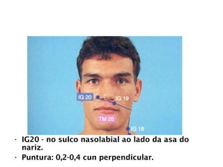 INTESTINO GROSSO
• IG20 - no sulco nasolabial ao lado da asa do
nariz.
• Puntura: 0,2-0,4 cun perpendicular.
 