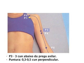 PULMÃO
• P3 - 3 cun abaixo da prega axilar.
• Puntura: 0,3-0,5 cun perpendicular.
 