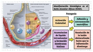 Manifestación histológica es el
daño alveolar difuso (DAD).
Patogenia
Activación
Endotelial
Adhesión y
extravasación
neutrófilos
Acumulacion
de liquido
intraalveolar
y formación
membranas
hialinas
Resolución de
la lesión
obstaculizada
hasta que la
inflamación
disminuya
 