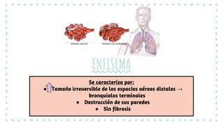 Se caracteriza por:
● Tamaño irreversible de los espacios aéreos distales →
bronquiolos terminales
● Destrucción de sus paredes
● Sin fibrosis
ENFISEMA
 