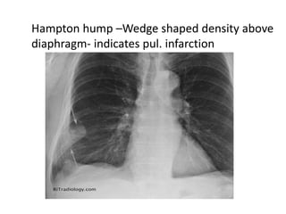 Hampton hump –Wedge shaped density above
diaphragm- indicates pul. infarction
 