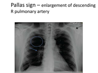 Pallas sign – enlargement of descending
R pulmonary artery
 