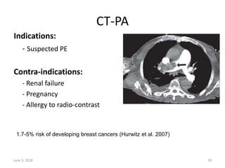 Indications:
- Suspected PE
Contra-indications:
- Renal failure
- Pregnancy
- Allergy to radio-contrast
1.7-5% risk of developing breast cancers (Hurwitz et al. 2007)
June 3, 2018 29
CT-PA
 