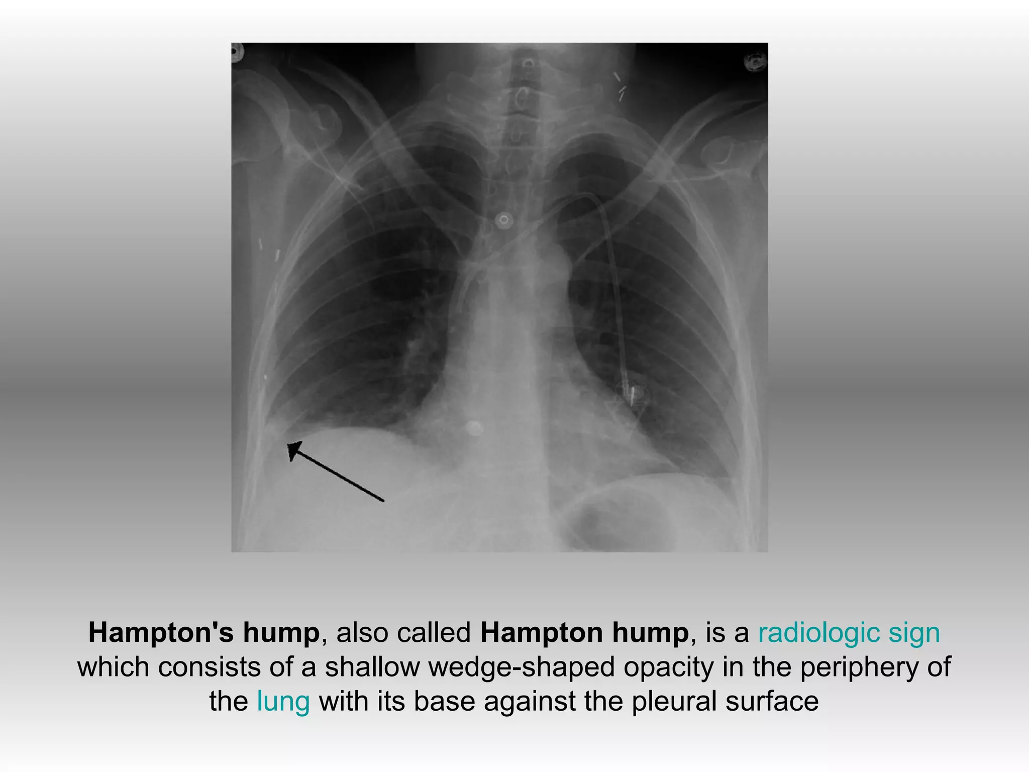 Hampton's hump, also called Hampton hump, is a radiologic sign
which consists of a shallow wedge-shaped opacity in the periphery of
         the lung with its base against the pleural surface
 