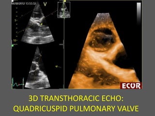 3D TRANSTHORACIC ECHO:
QUADRICUSPID PULMONARY VALVE
 