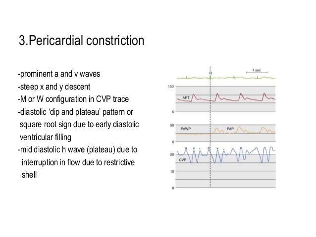 Pulmonary Artery Catheter2