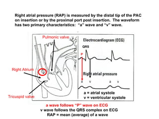 Pulmonary-Artery-Pressure-Monitoring.ppt