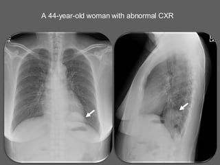 A 44-year-old woman with abnormal CXR 