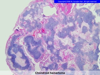 Chondroid hamartoma 