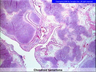 Chondroid hamartoma 