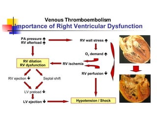 Preload Effected Rv Infarct Pulmonary Embolism | PPT