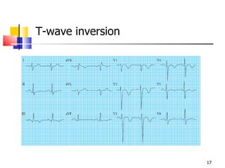 T-wave inversion 