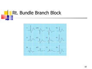 Rt. Bundle Branch Block 