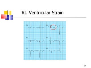 Rt. Ventricular Strain 