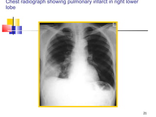Chest radiograph showing pulmonary infarct in right lower lobe 