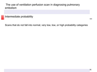 The use of ventilation perfusion scan in diagnosing pulmonary embolism Intermediate probability Scans that do not fall into normal, very low, low, or high probability categories 