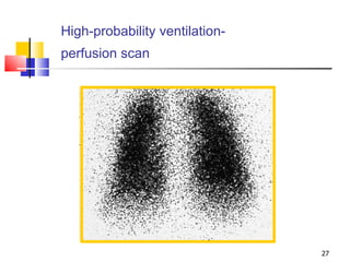 High-probability ventilation-perfusion scan   